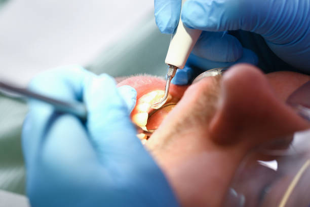 Urgent Tooth Repair in NC